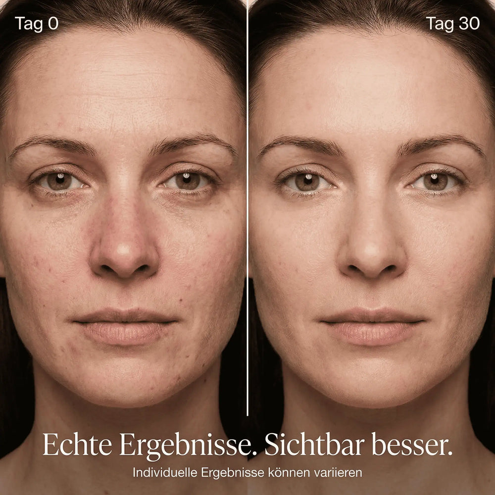 Vorher-Nachher Vergleich Tag 0 vs. Tag 30: sichtbar glatterer, ebenmäßigerer Teint nach Lichttherapie-Routine mit Mini Diva Beauty