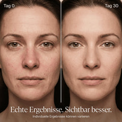 Vorher-Nachher Vergleich Tag 0 vs. Tag 30: sichtbar glatterer, ebenmäßigerer Teint nach Lichttherapie-Routine mit Mini Diva Beauty
